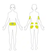 Sites de pose du set de perfusion